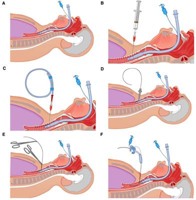 A safer and more practical tracheotomy in invasive mechanical ventilated patients with COVID-19: A quality improvement study